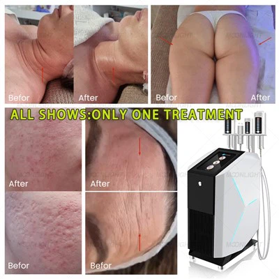 SlimSphere Roller Θεραπεία
